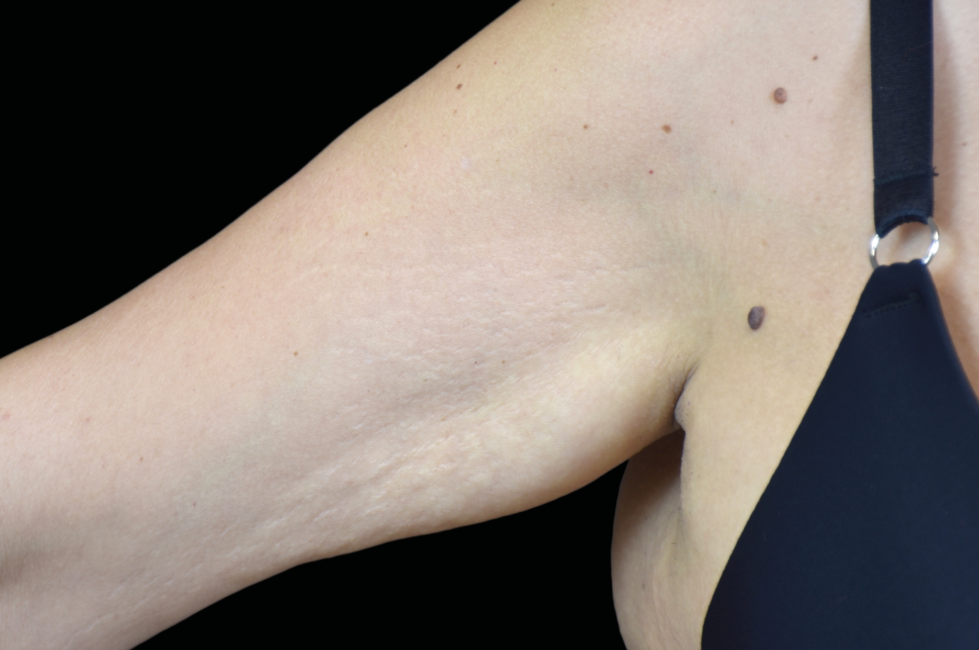 Emtone Before & After Gallery - Patient 106717 - Image 2