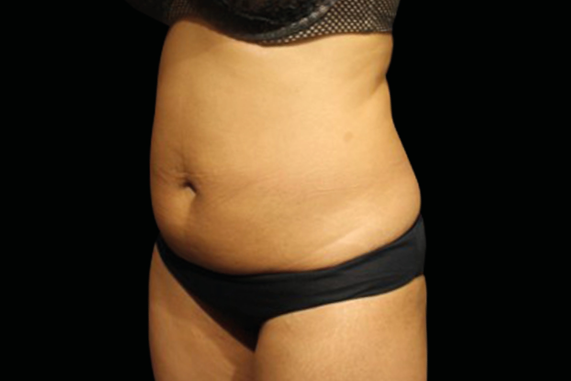 Emtone Before & After Gallery - Patient 685589 - Image 1