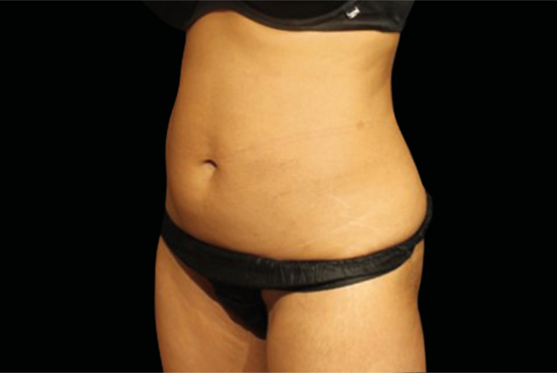 Emtone Before & After Gallery - Patient 685589 - Image 2