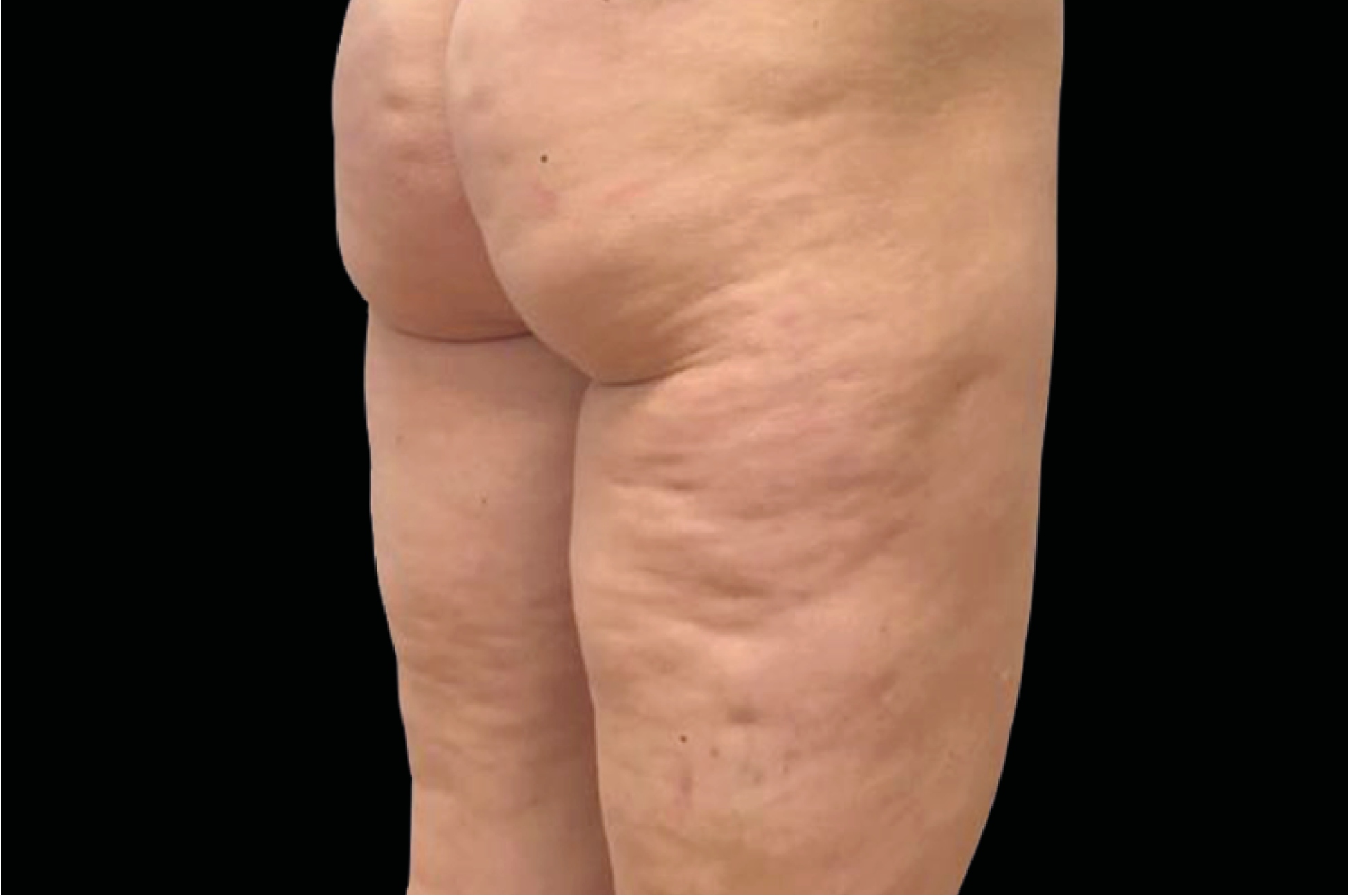 Emtone Before & After Gallery - Patient 214545 - Image 1