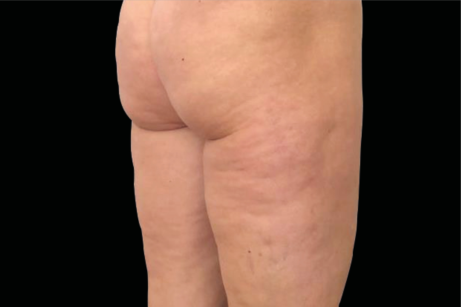 Emtone Before & After Gallery - Patient 214545 - Image 2