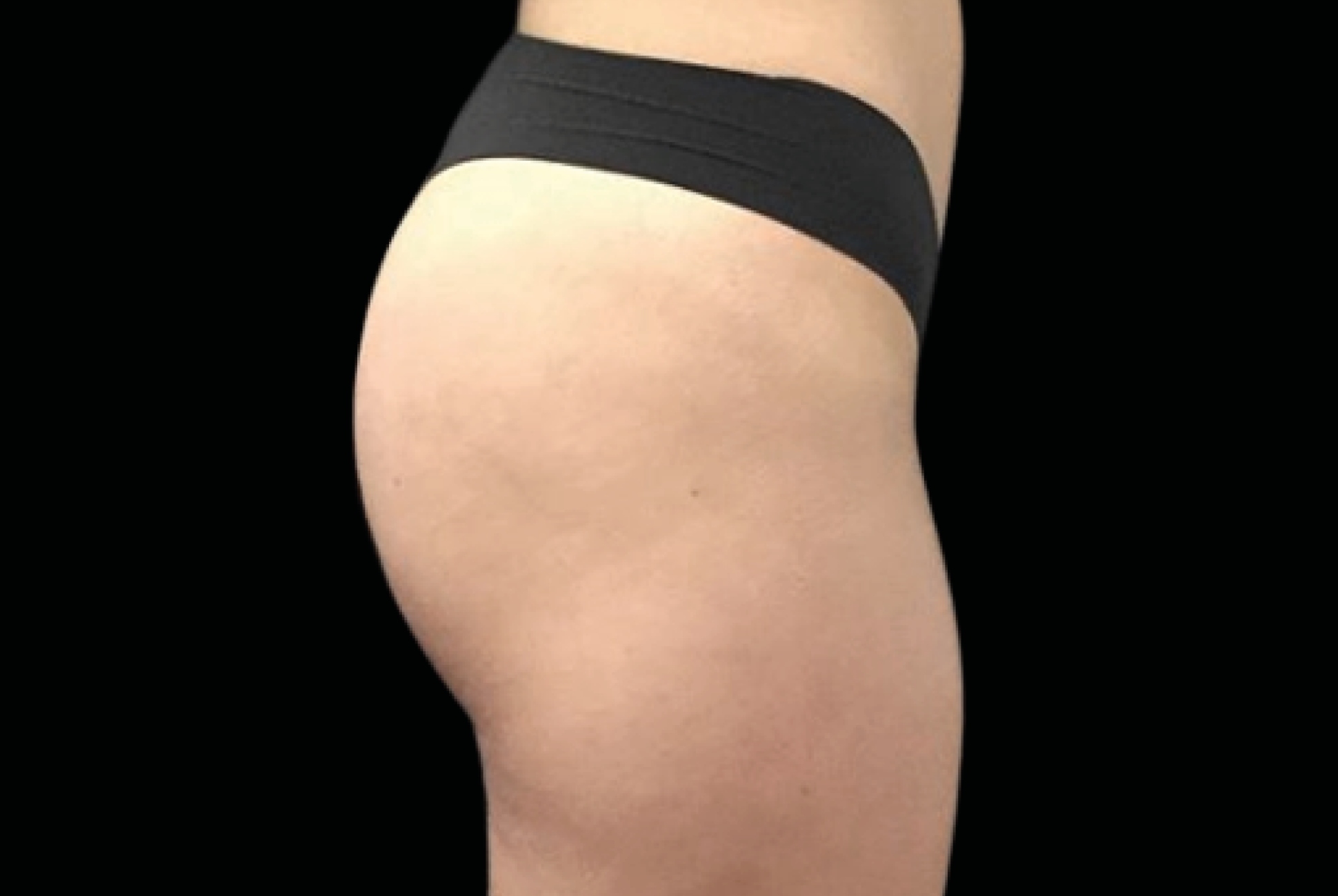 Emsculpt Neo Before & After Gallery - Patient 104844 - Image 1