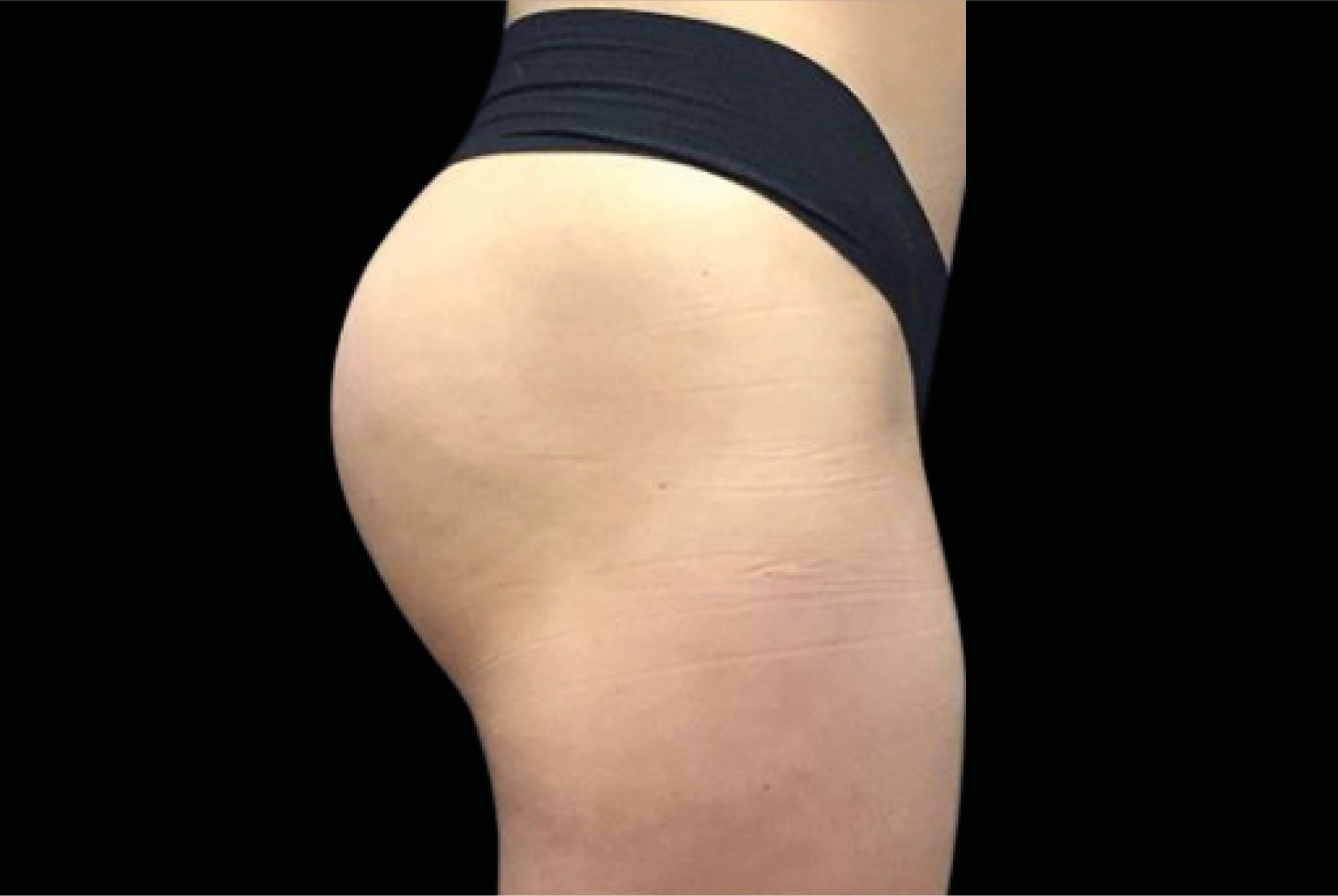 Emsculpt Neo Before & After Gallery - Patient 104844 - Image 2