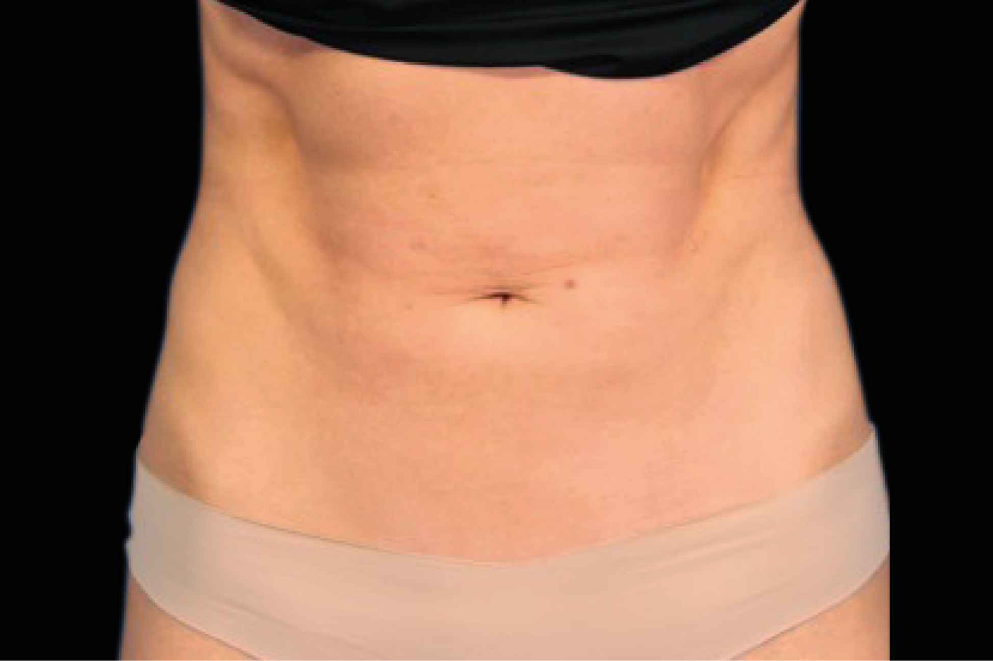 Emsculpt Neo Before & After Gallery - Patient 202078 - Image 2