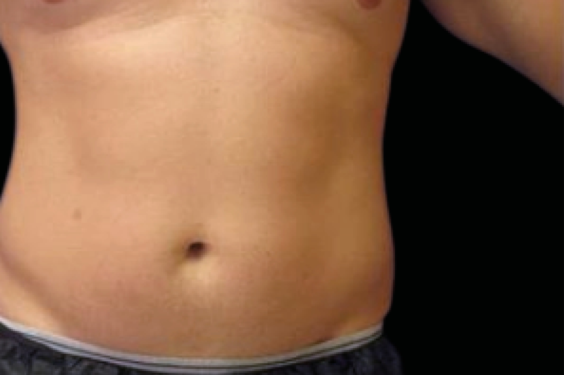 Emsculpt Neo Before & After Gallery - Patient 426036 - Image 1