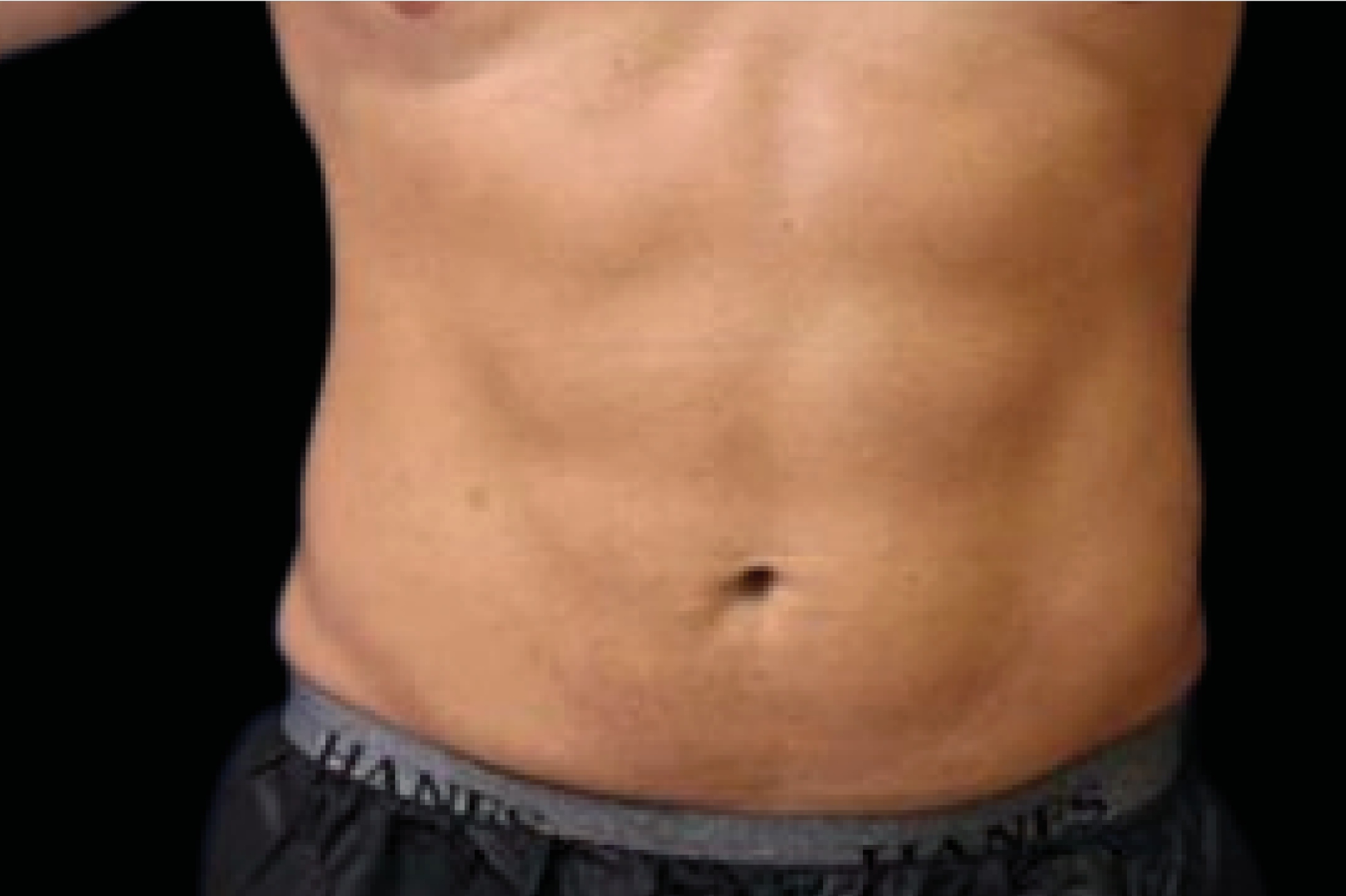 Emsculpt Neo Before & After Gallery - Patient 426036 - Image 2