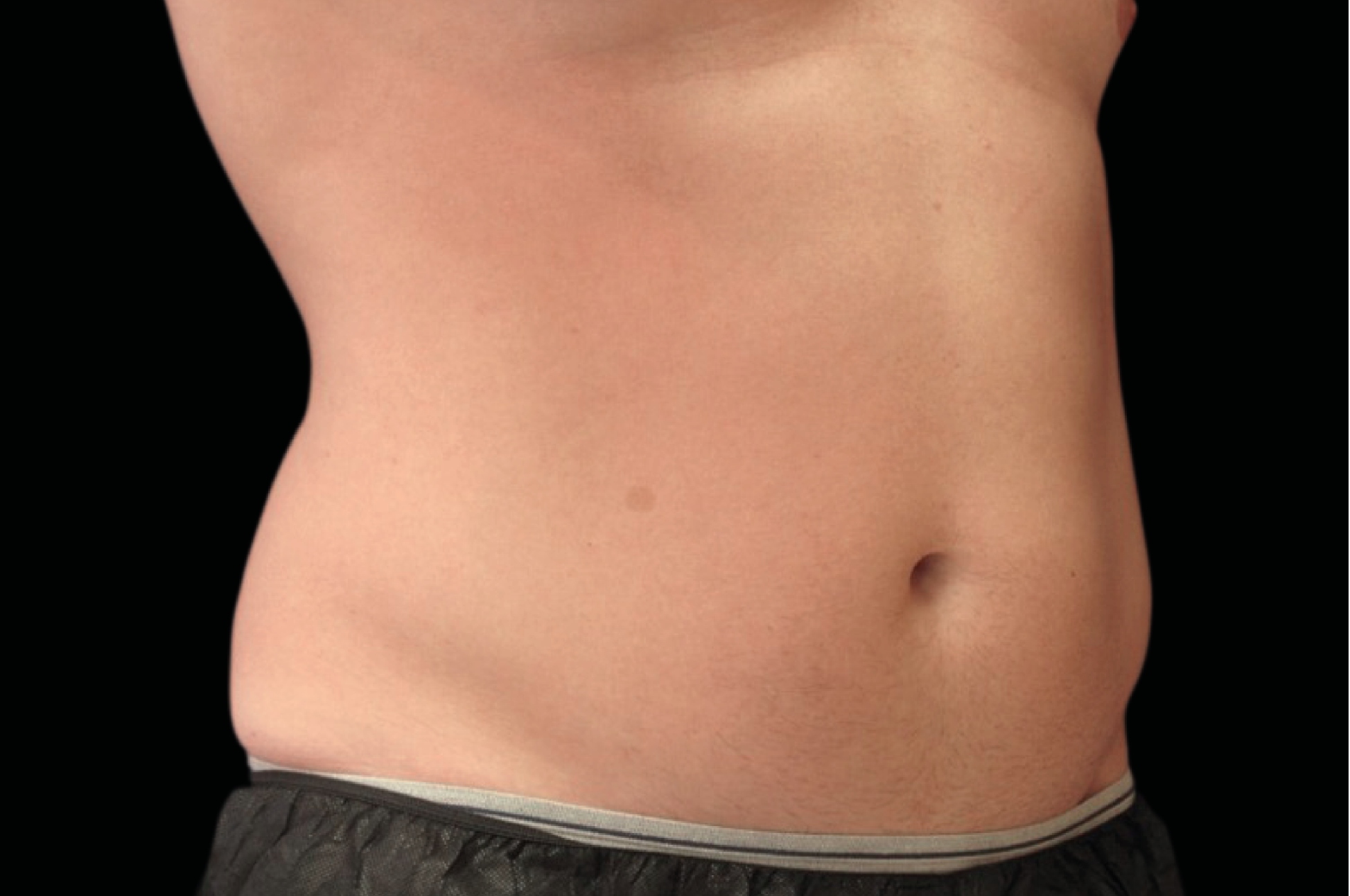 Emsculpt Neo Before & After Gallery - Patient 426036 - Image 3