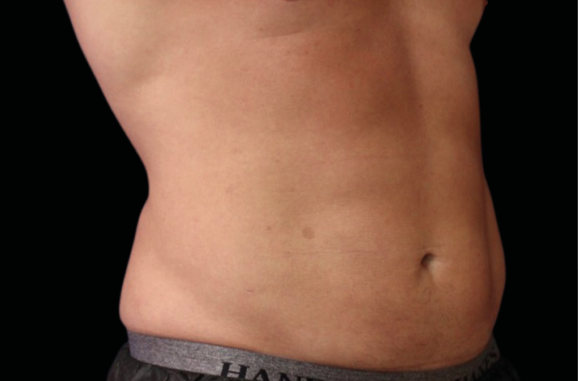 Emsculpt Neo Before & After Gallery - Patient 426036 - Image 4