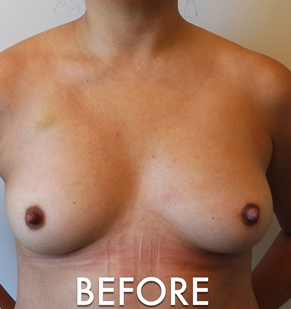 Fat Grafting to Breast Before & After Gallery - Patient 561847 - Image 1