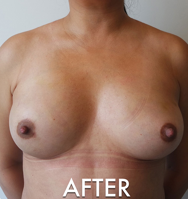 Fat Grafting to Breast Before & After Gallery - Patient 561847 - Image 2