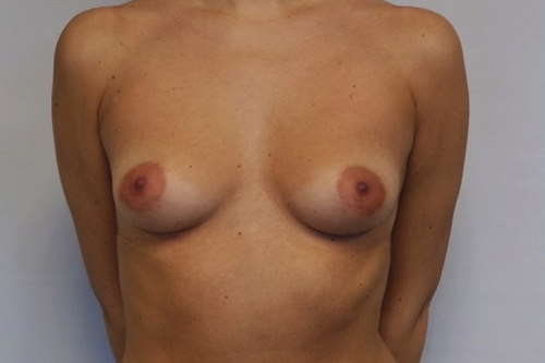 Breast Lift Before & After Gallery - Patient 361539 - Image 1
