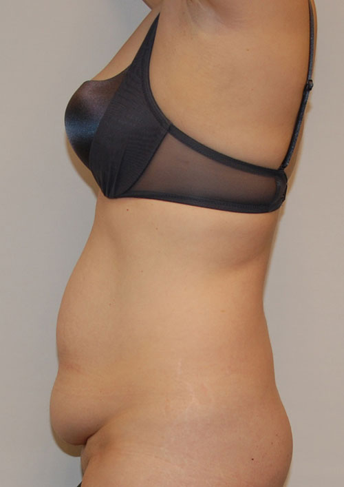 Tummy Tuck Before & After Gallery - Patient 197550 - Image 1