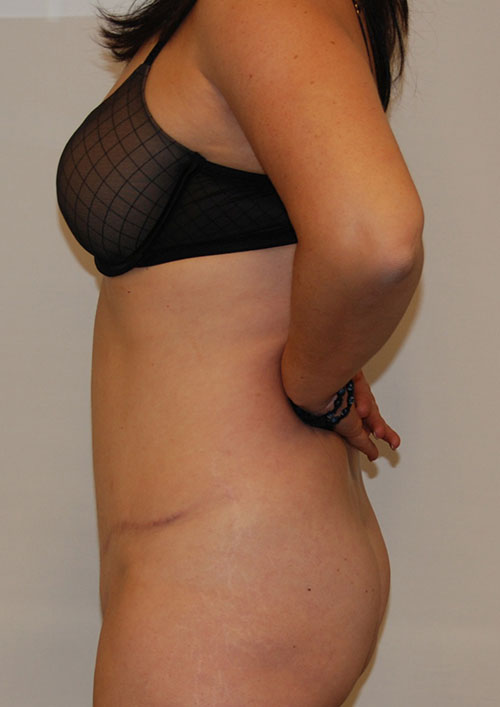 Tummy Tuck Before & After Gallery - Patient 197550 - Image 2