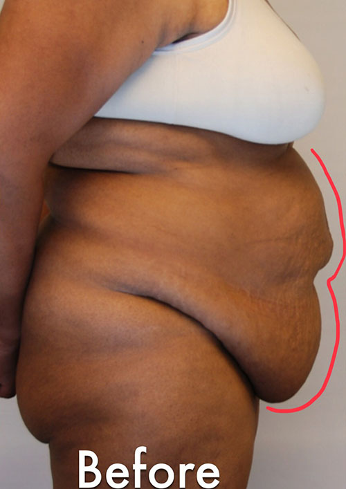 Tummy Tuck Before & After Gallery - Patient 171729 - Image 1