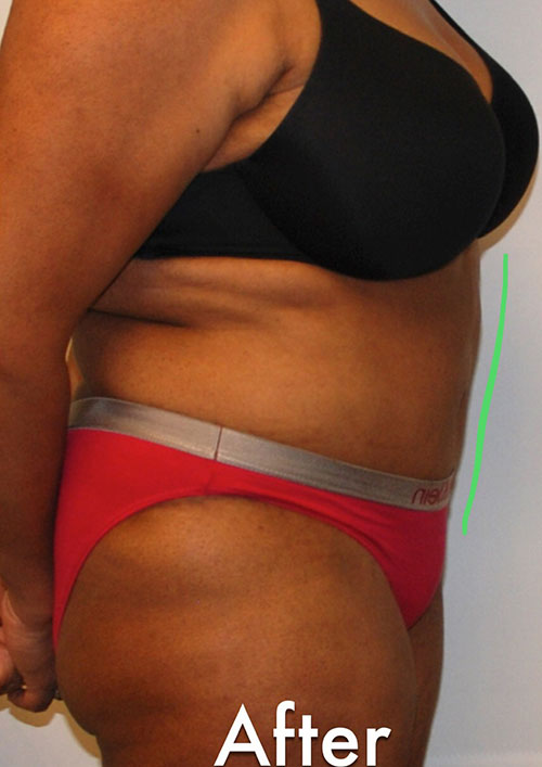 Tummy Tuck Before & After Gallery - Patient 171729 - Image 2