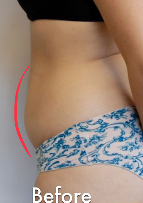 Tummy Tuck Before & After Gallery - Patient 303480 - Image 1