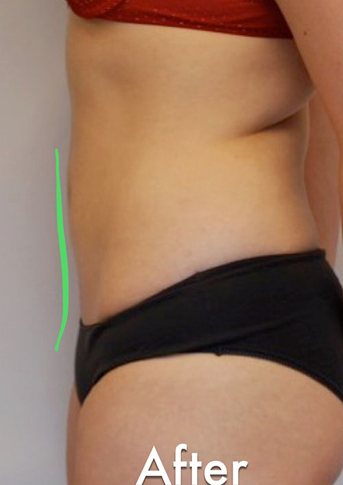 Tummy Tuck Before & After Gallery - Patient 303480 - Image 2