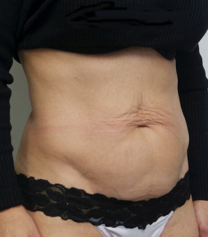 Tummy Tuck Before & After Gallery - Patient 427485 - Image 1