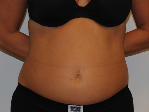 Liposuction Before & After Gallery - Patient 216064 - Image 1