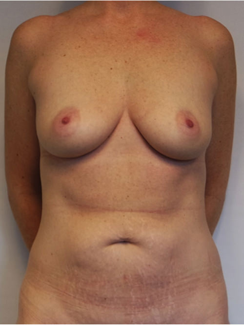 Mommy Makeover Before & After Gallery - Patient 389654 - Image 1