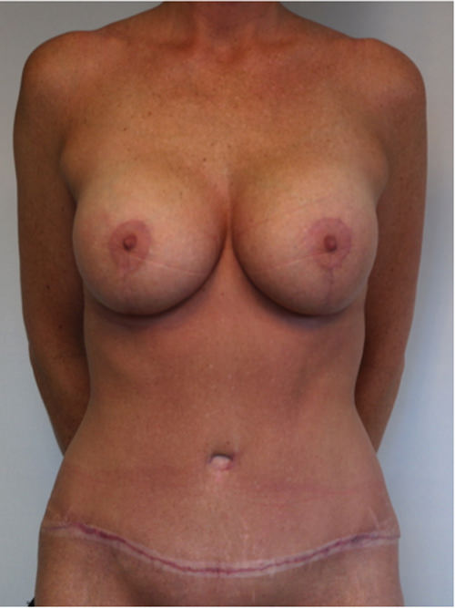 Mommy Makeover Before & After Gallery - Patient 389654 - Image 2