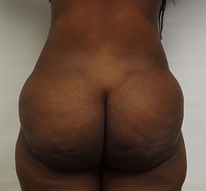 Brazilian Butt Lift Before & After Gallery - Patient 103629 - Image 1