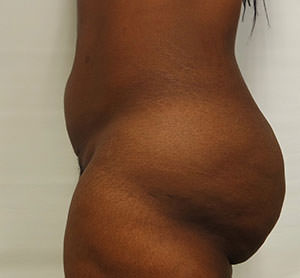 Brazilian Butt Lift Before & After Gallery - Patient 103629 - Image 3