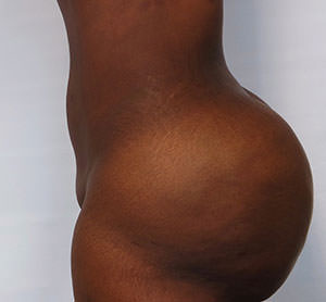 Brazilian Butt Lift Before & After Gallery - Patient 103629 - Image 4