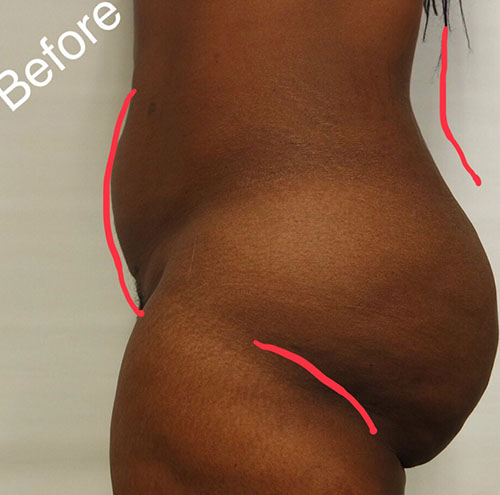 Brazilian Butt Lift Before & After Gallery - Patient 319858 - Image 1