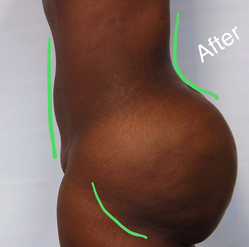 Brazilian Butt Lift Before & After Gallery - Patient 319858 - Image 2