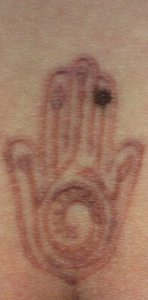 Pico Way (Tattoo Removal) Before & After Gallery - Patient 121143 - Image 1