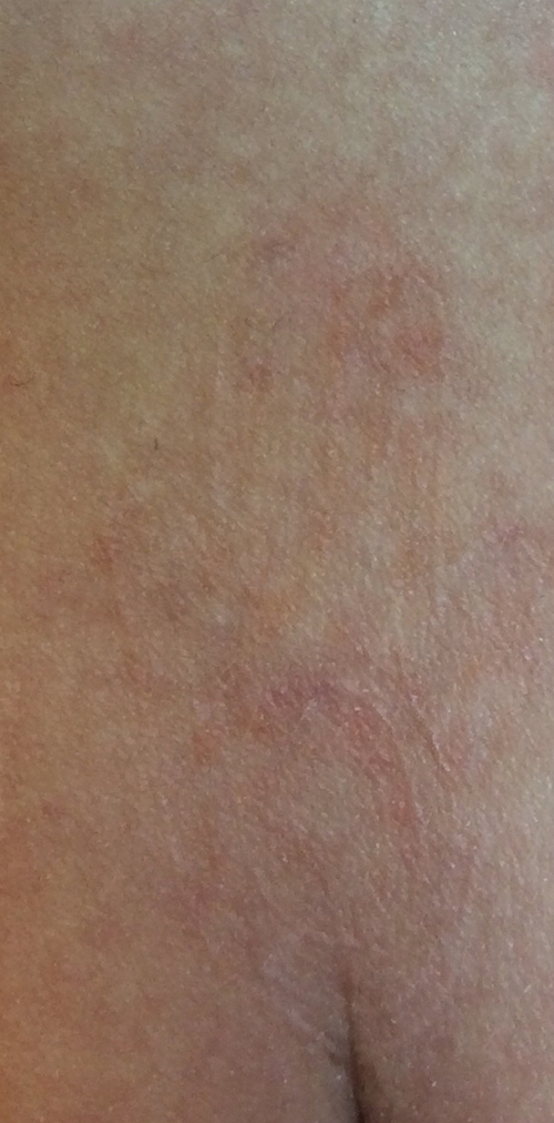 Pico Way (Tattoo Removal) Before & After Gallery - Patient 121143 - Image 2