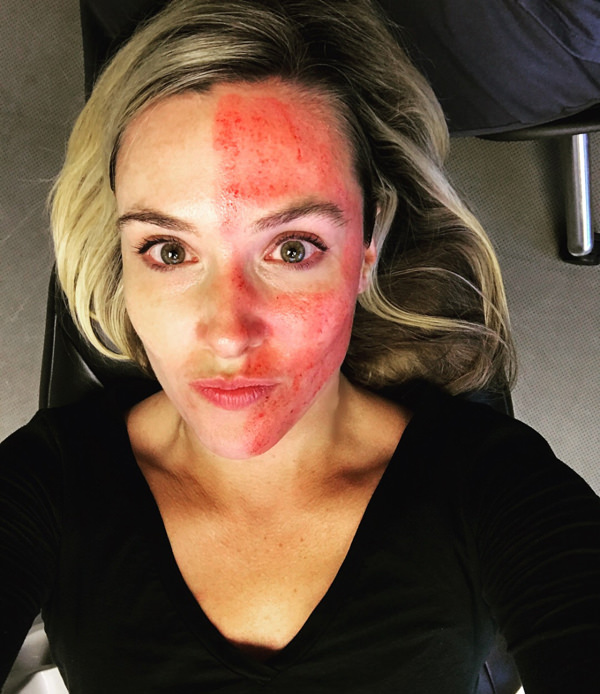 vampire facial on a woman