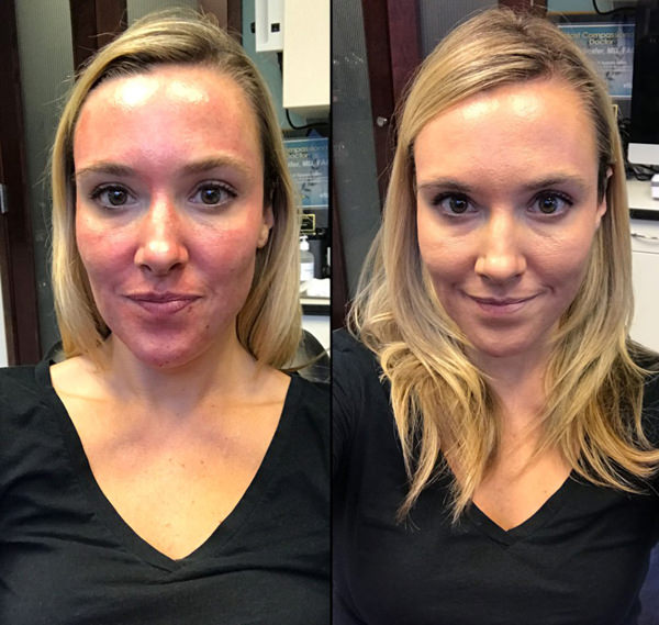 before and after vampire facial